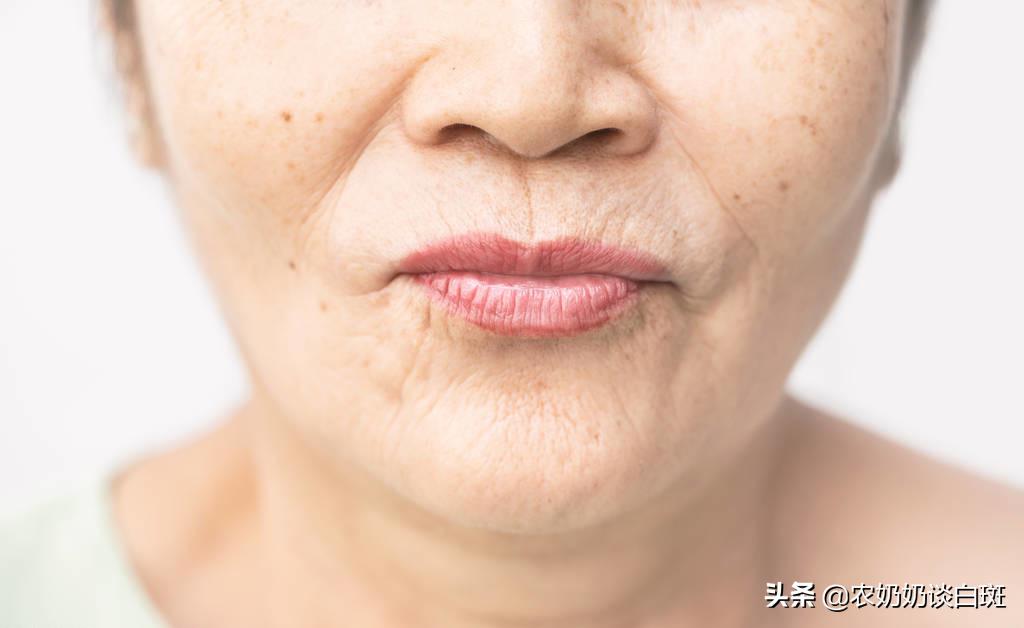 白癜风吃什么防止扩散,白癜风患者盐吃多了会怎么样