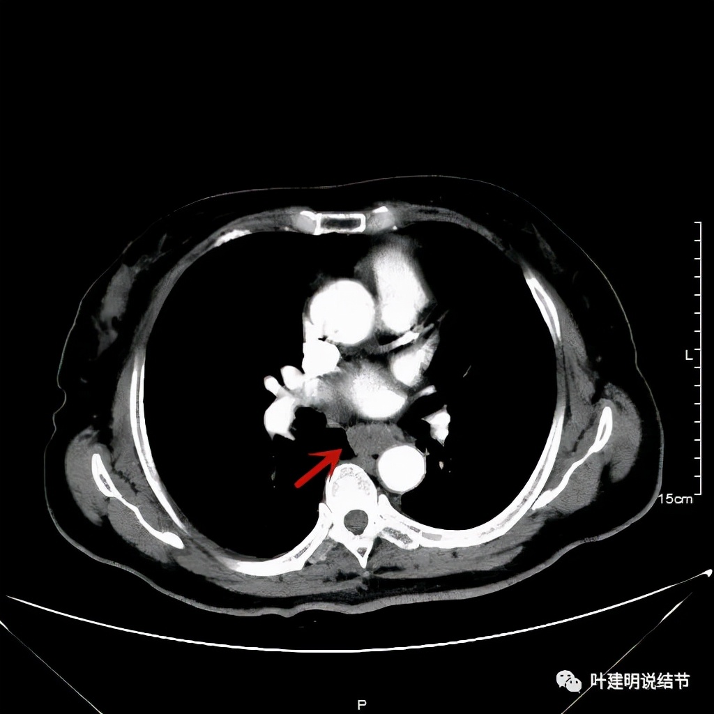 特瑞普利单抗食管癌成功案例,特瑞普利单抗治疗食管癌效果好吗