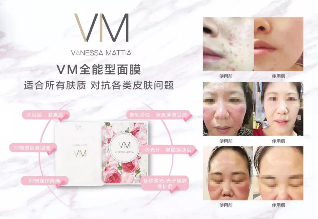 vm玻璃面膜和vm瀑布面膜区别,vm瀑布鎏金面膜含激素吗