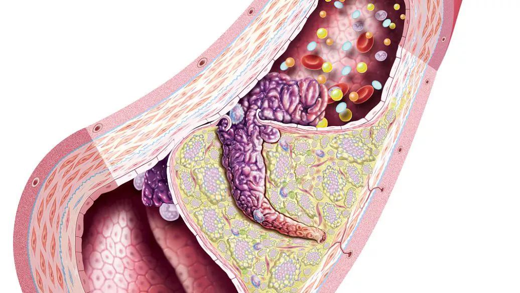 治疗血脂高中药有哪几种,血脂高中药怎么调理