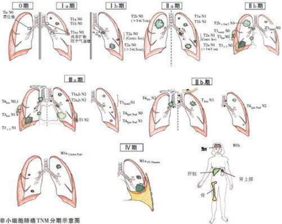 正确认识癌细胞,正确认识甲状腺癌