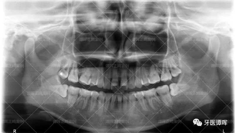 门牙前突牙齿不齐矫正案例分享,门牙和旁边牙齿不齐最快矫正方法