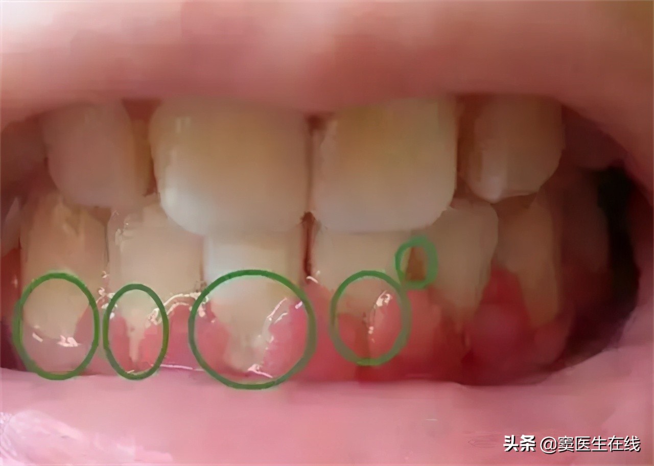 用手抠牙齿手上有臭味,牙缝一抠出血有臭味