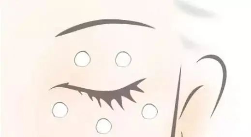 拯救你的卡路里电影,眼部脂肪粒怎么拯救