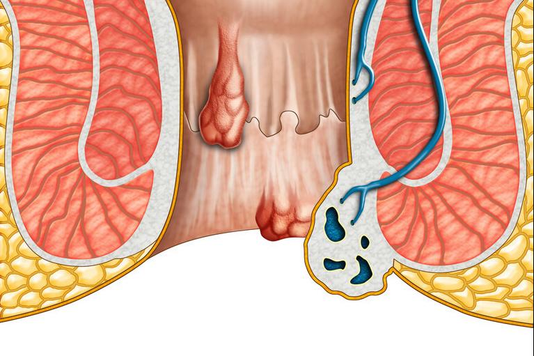 十人九痔疮是真实的吗,十人九痔疮是什么原因