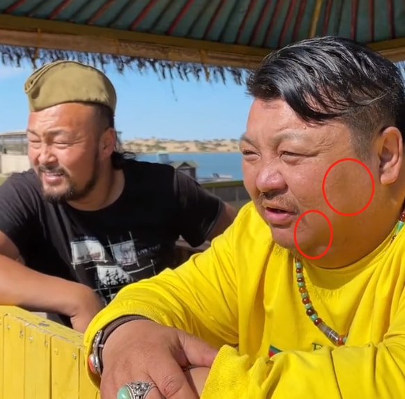 恩克脸上的黑斑,恩克面部频繁出现黑斑