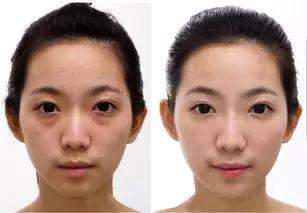 眼袋发青怎么祛除眼袋,怎样去除眼袋最好最有效的方法