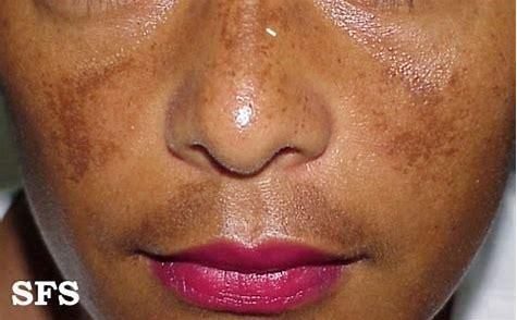 五天根治雀斑老年斑,有效的去除雀斑和老年斑的方法