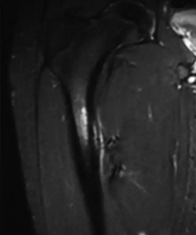 骨折处出现麻痹感,骨折跟精神状态有关