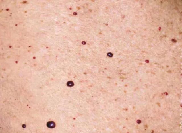 乙肝患者皮肤发黄还意味着什么,乙肝患者皮肤出现红点