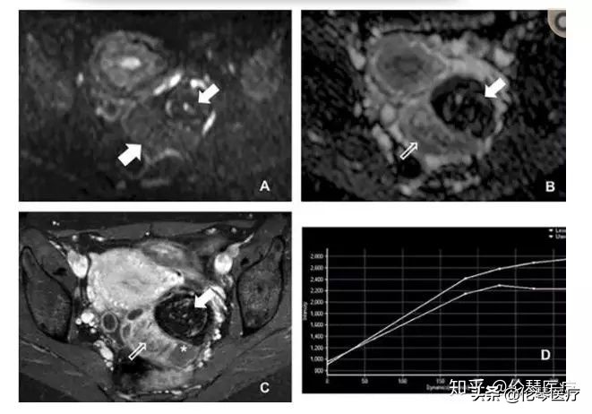 卵巢肿瘤核磁共振能看出来吗,超声测出来肿瘤