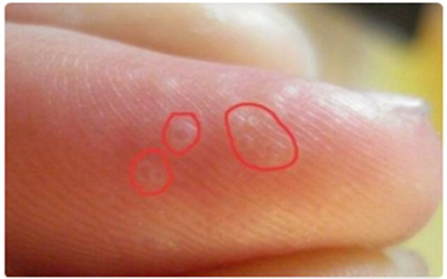 一到夏天手就长汗疱疹怎么回事,一到夏天手上就长小水泡
