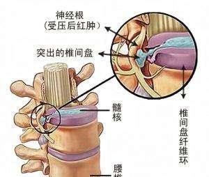 腰突坐骨神经痛最快的治疗方法,百年扁氏老黑膏治疗腰突有效吗