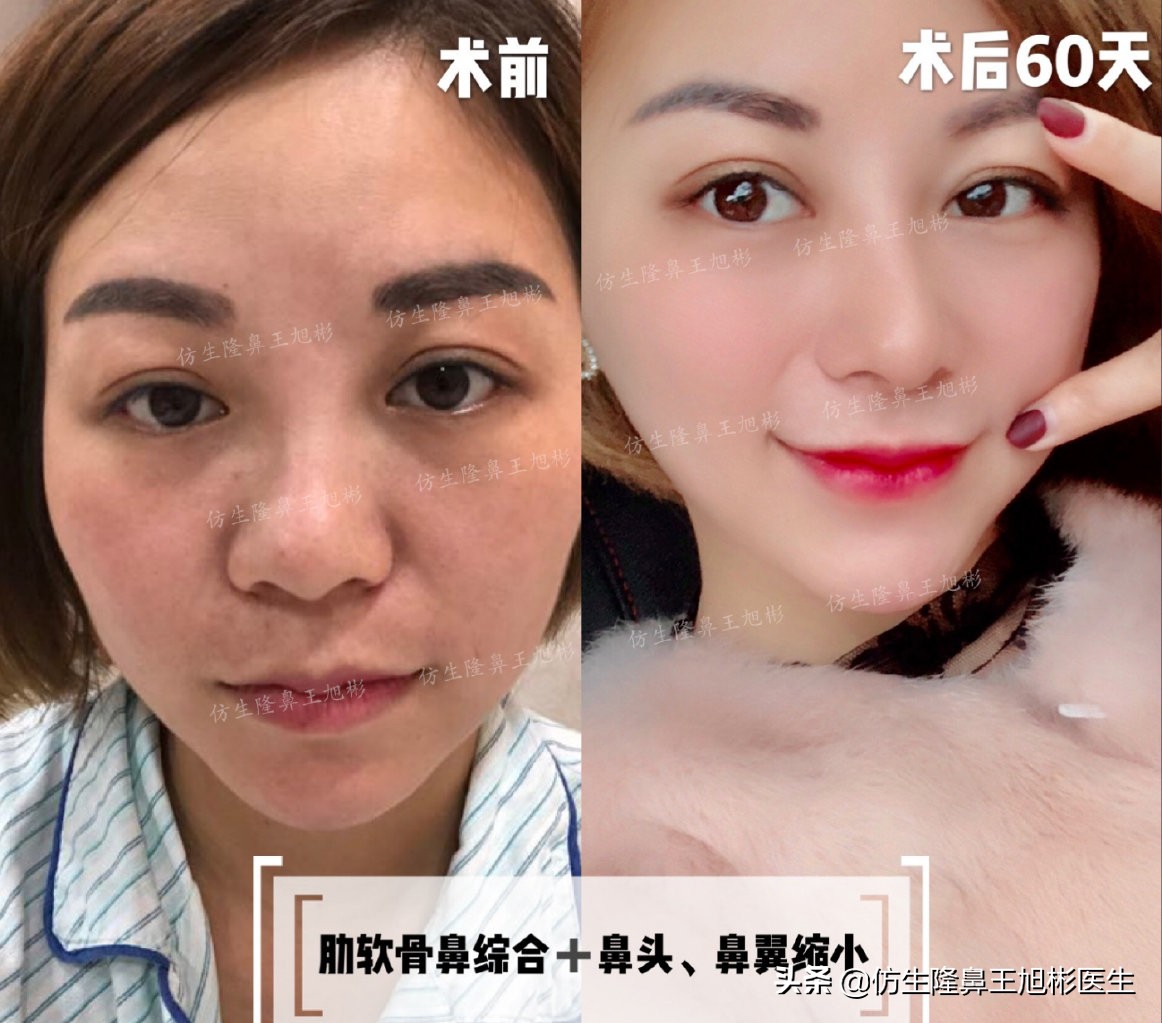 短鼻延长的最佳方法,短鼻修复前后对比案例