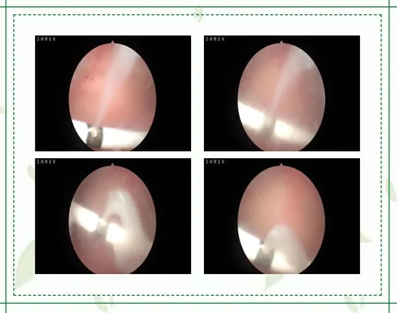 小结石有可能引起潜血吗,小结石引起的肾积水要紧吗