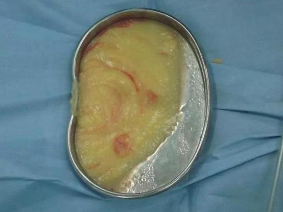 母乳导致孩子发黄,母乳性黄疸宝宝皮肤发黑