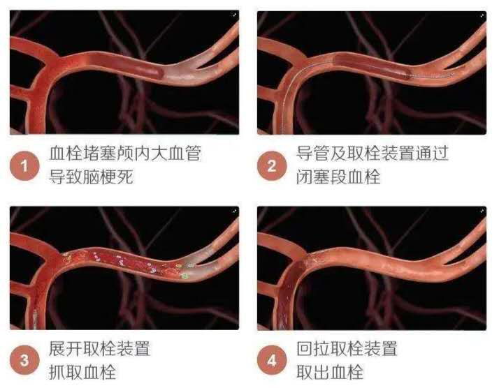 大脑动脉闭塞脑梗死怎么引起的,脑梗死的血管闭塞怎么治疗