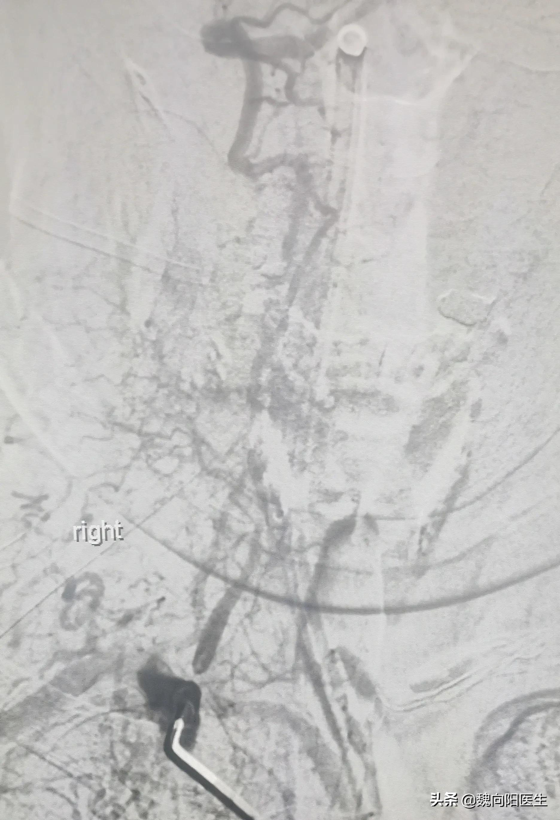 细若头发丝的椎动脉引发严重脑梗塞，开通之后希望早日康复