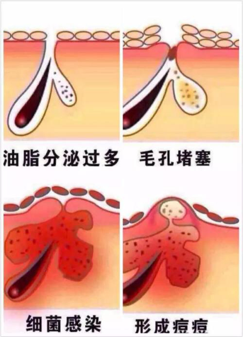 暗疮消炎能消掉么,大暗疮用什么消炎最快