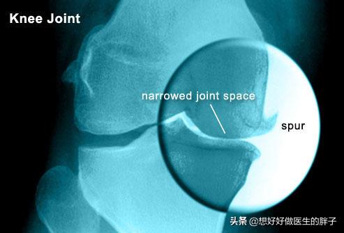 膝盖骨刺初期有什么症状,膝盖骨刺最严重后果怎样