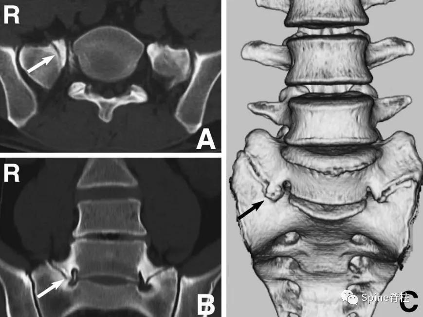 下肢疼痛是腰椎间盘突出引起的吗,下肢放射痛查不出原因