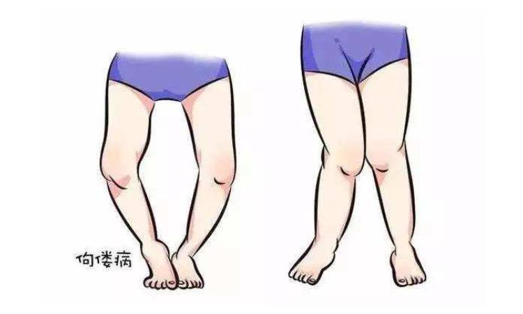 心肌营养不良症状及表现,孕期营养不良有哪些表现