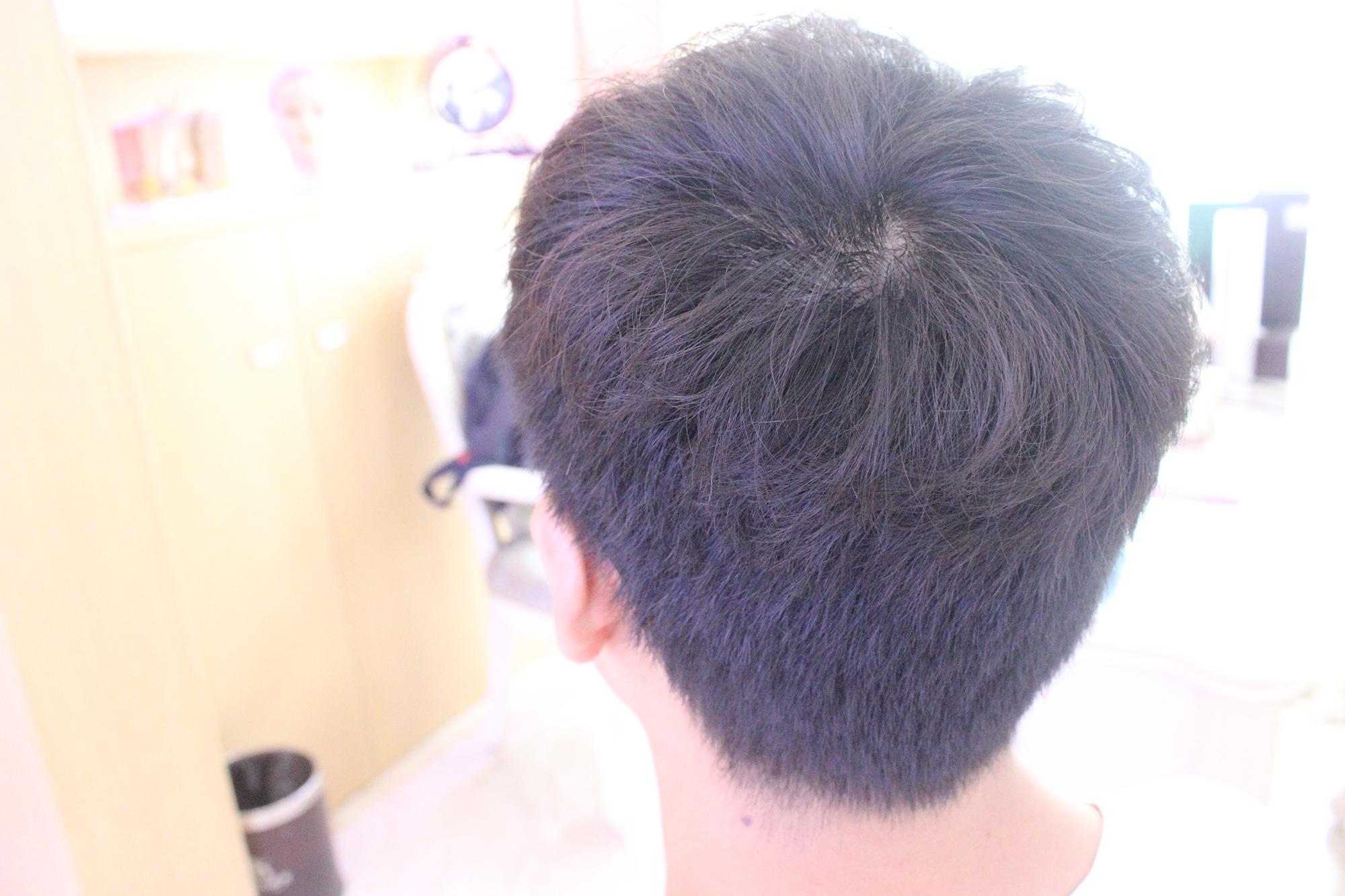 植发靠谱吗,植发价格一般多少钱