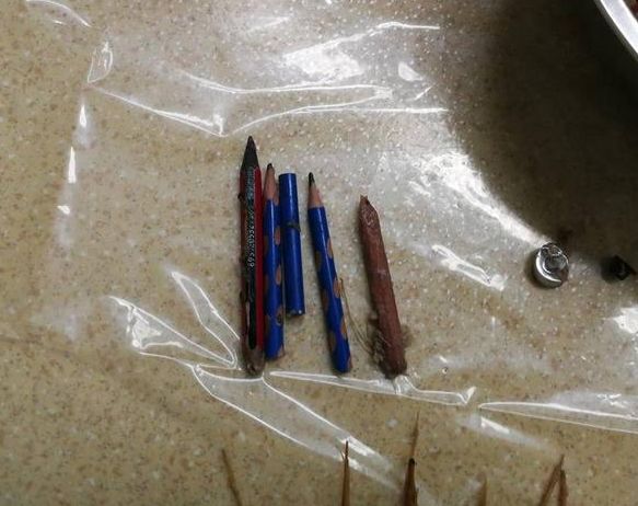 二十岁男孩腹痛住院手术取出,9岁小孩腹痛取出来的东西