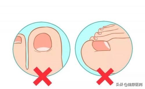 指甲也能剪出错？甲沟炎找上门痛不欲生！这才是剪指甲的正确方式