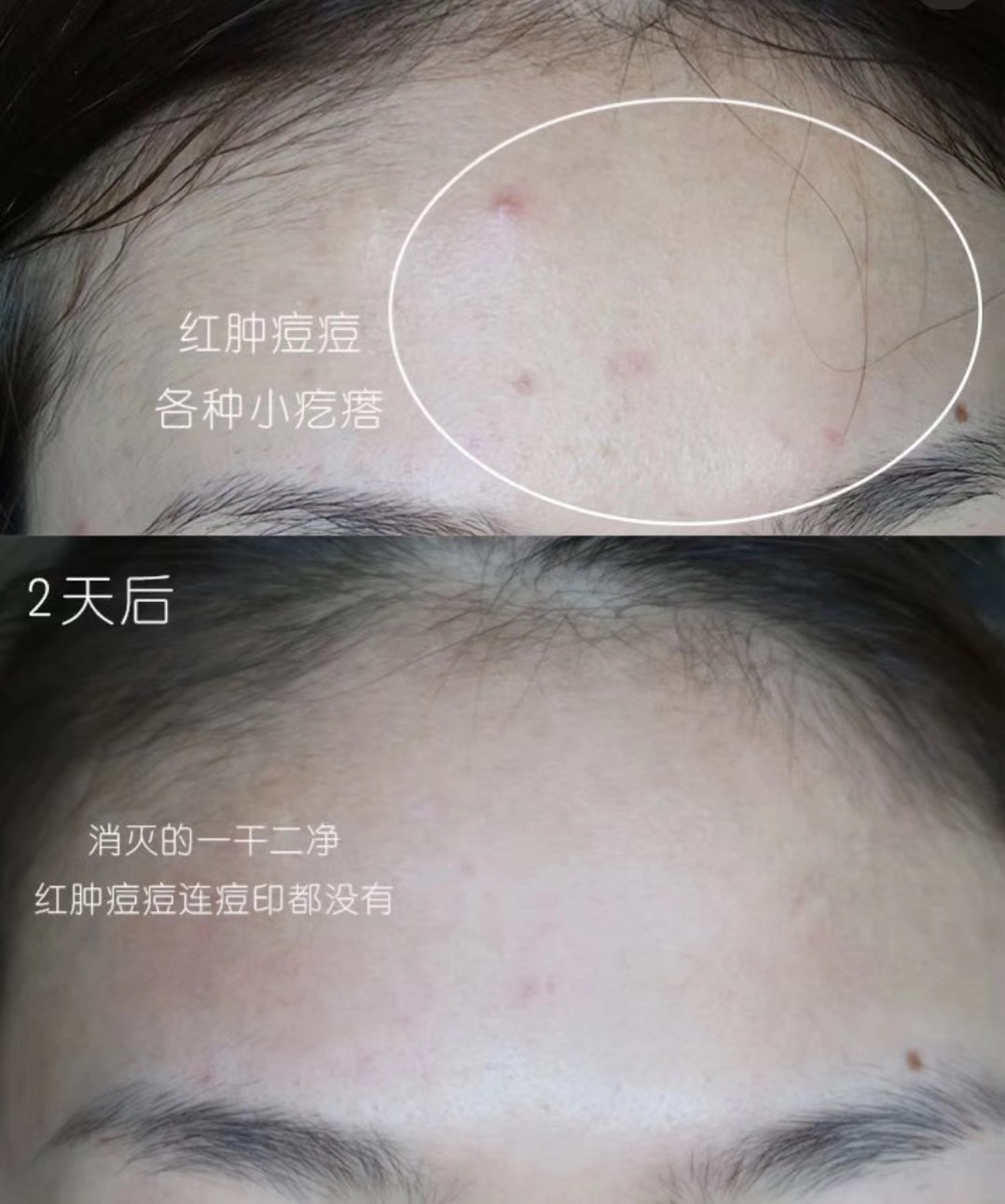 爱长痘的姐妹看过来,爱长痘的女生用什么水乳