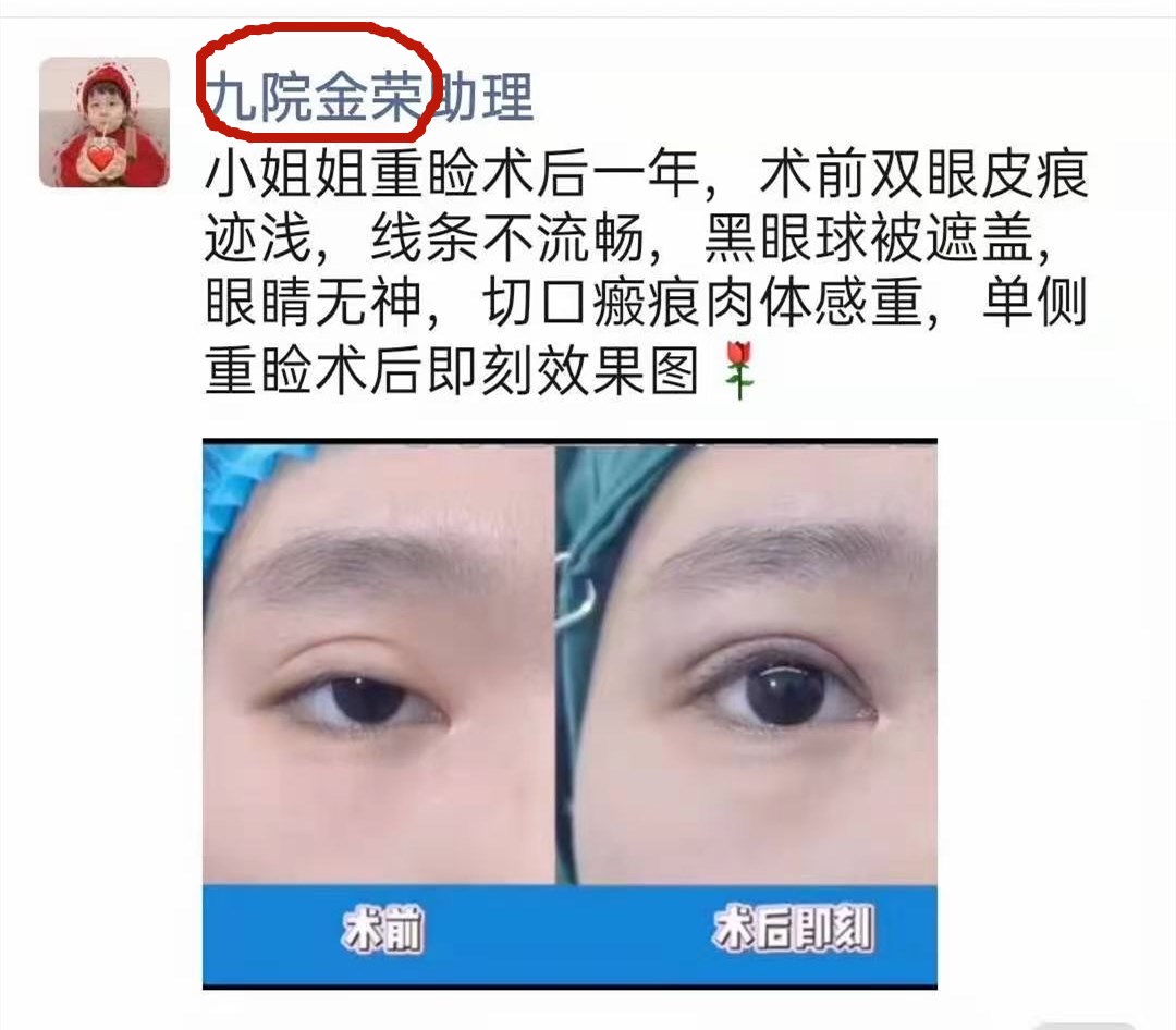 单眼上睑下垂修复术,上睑下垂眼睛修复手术成功率高吗