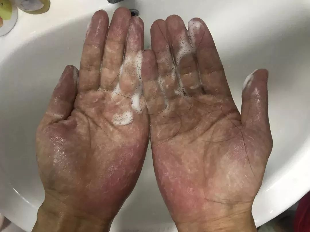 “十男八秃”的日本男人疯抢这瓶小黑钻!让头发不再掉了