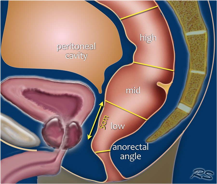 直肠癌“保肛”,你必须知道的知识