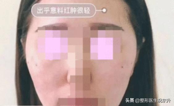 线雕后脸变宽眼睛变小了,线雕后脸变宽了多久能恢复