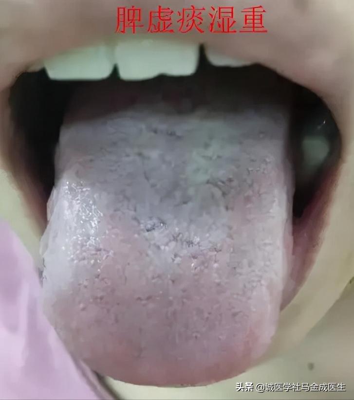 脾虚齿痕舌整天乏困吃什么中成药,治疗脾虚齿痕舌最好的中成药