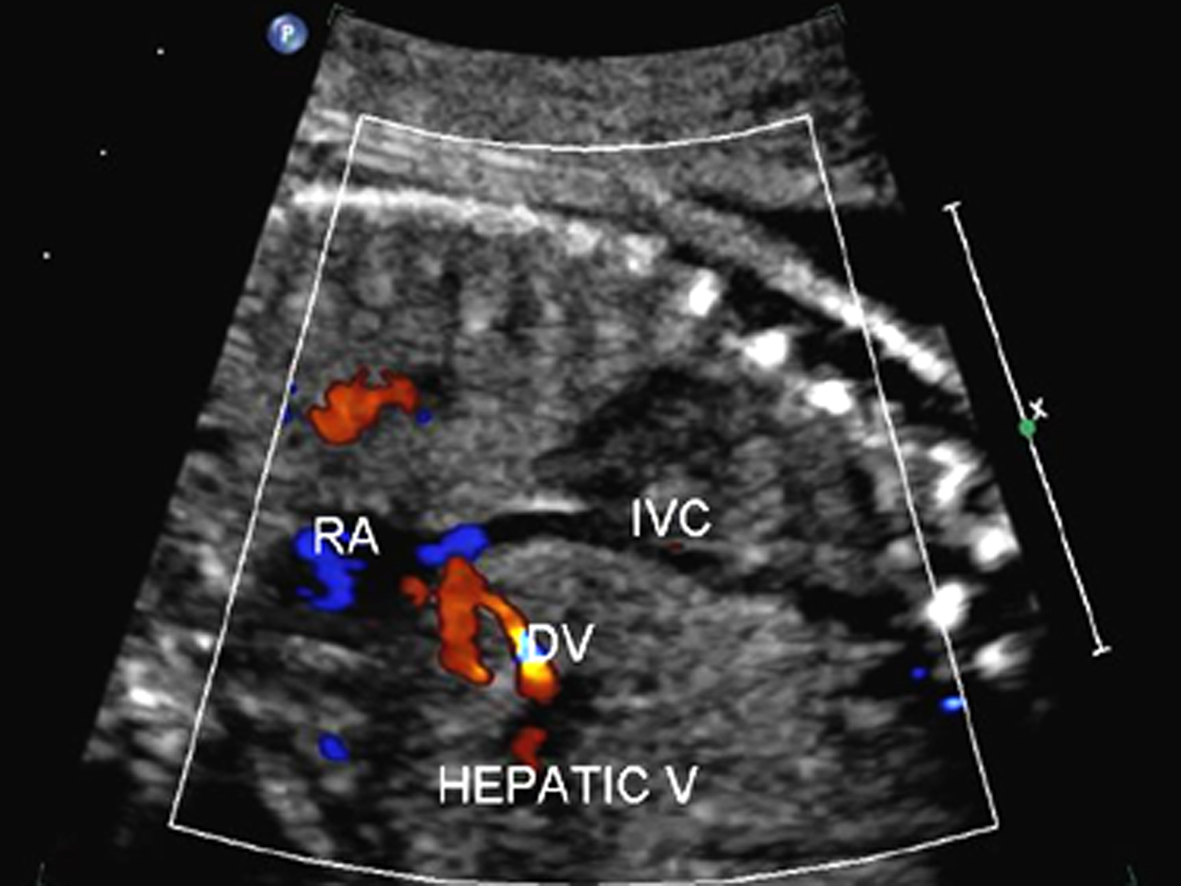 做彩超显示胎儿内脏在右边正常吗,胎儿系统性彩色多普勒超声筛查