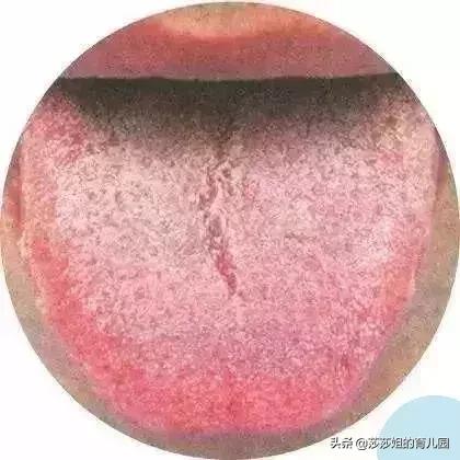 孩子的舌头有裂纹，红点意味着什么？吃什么能够去除？