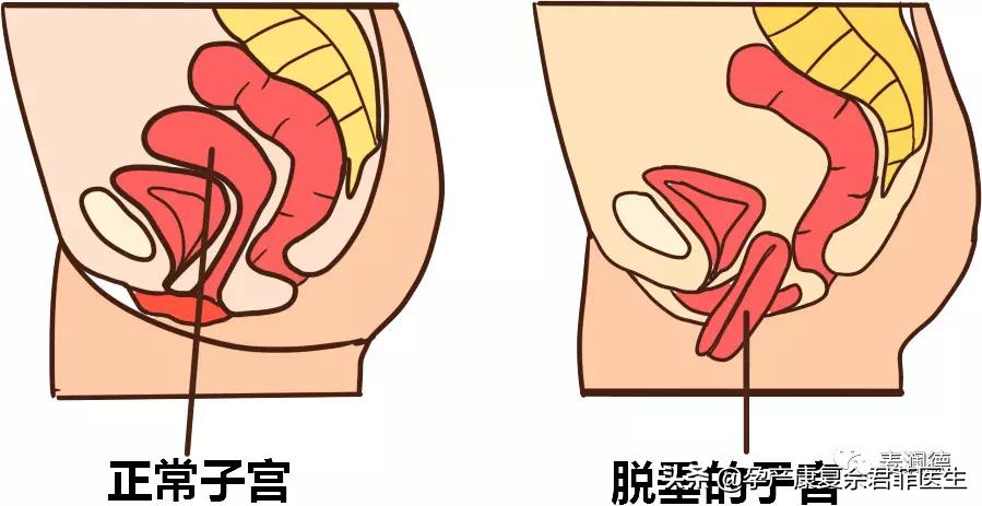 盆底知识问答,保护盆底的正确方法