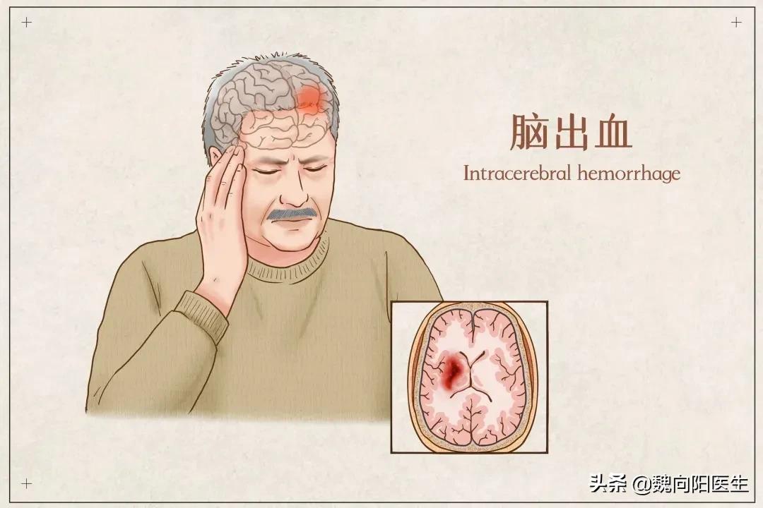 脑出血昏迷一个月还能醒来吗,车祸脑出血两个月还昏迷能醒来吗