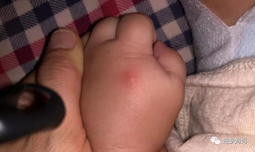 宝宝起疹子妈妈需要忌口吗,宝宝起湿疹妈妈着急