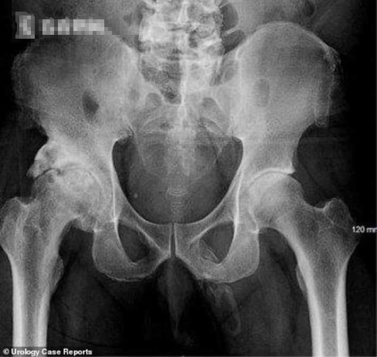 14岁男生把9厘米缝衣针插入尿道，痛苦三天去就医，网友：爽吗？