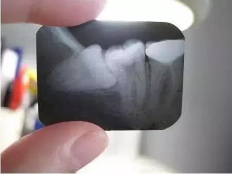 智齿冠周炎引起的下颌骨疼痛,智齿冠周炎张口受限伴吞咽疼痛