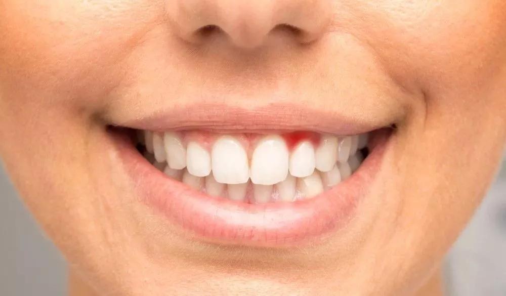 解决牙龈出血你需要知道的所有事,牙龈出血一定要警惕