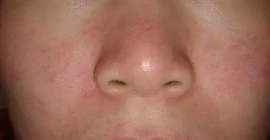 外用药物有刺激,想弃疗,可以这么整