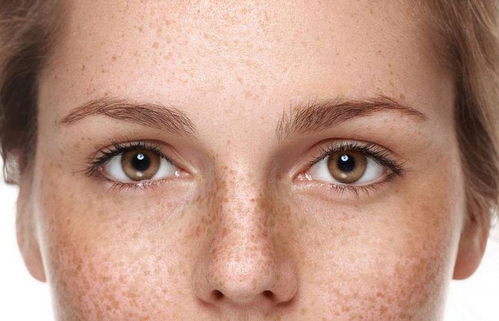 叙美雅祛斑后很红正常吗,叙美雅祛斑修复过程大概要多久