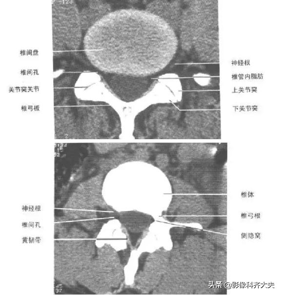 腰椎间盘突出是什么,腰椎间盘突出和腰间盘突出有区别吗