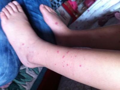 腹型过敏性紫癜治好了注意什么,过敏性紫癜饮食上要注意些什么