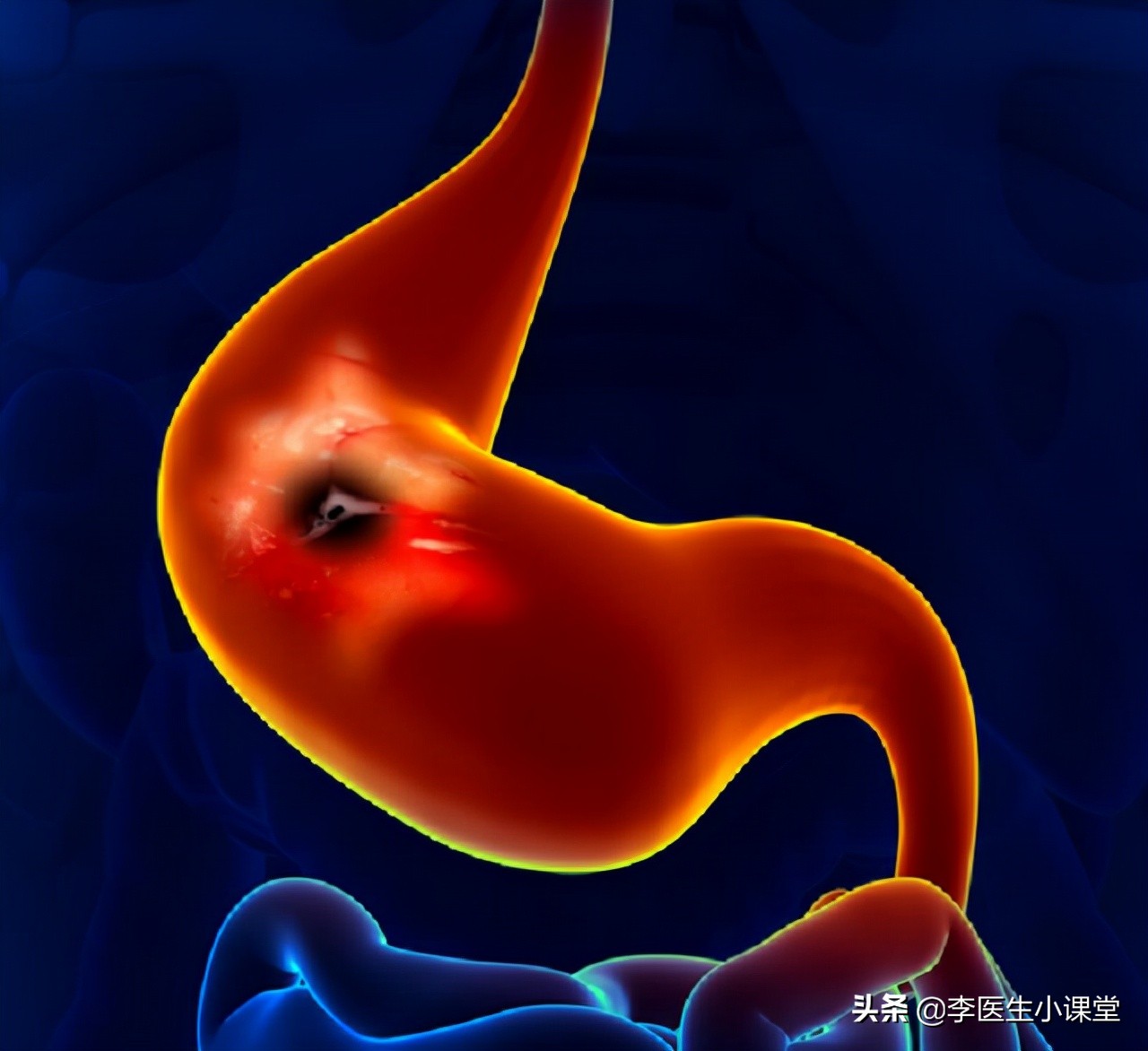 阿司匹林容易出血还能吃吗,阿司匹林引起的消化道出血怎么治