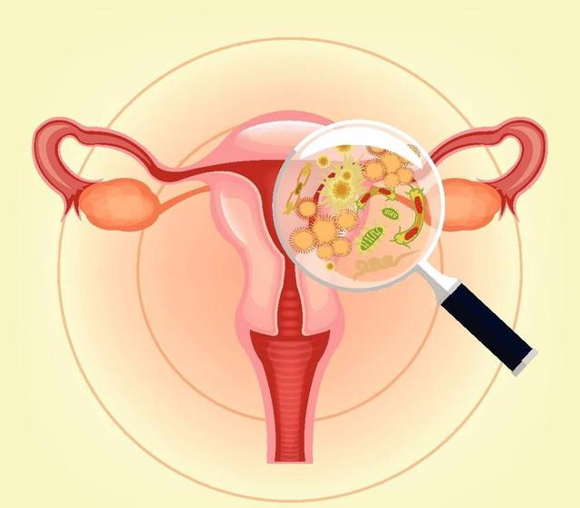 50岁女人盆腔感染的危害,女性最容易感染的妇科病