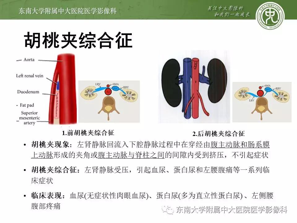 肠系膜上动脉压迫综合征挂什么科,肠系膜上动脉压迫综合征手术费用